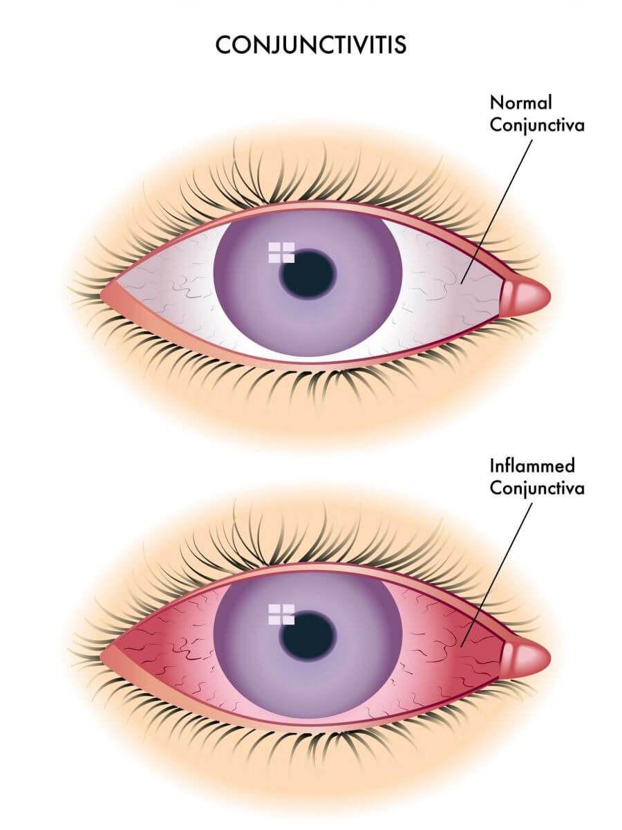 ontsteking aan het oog