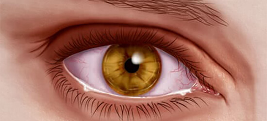 Oorzaak van droge ogen