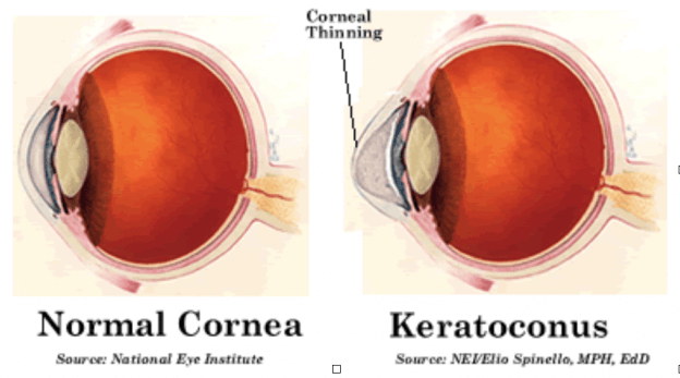 wat is keratoconus en de oorzaak