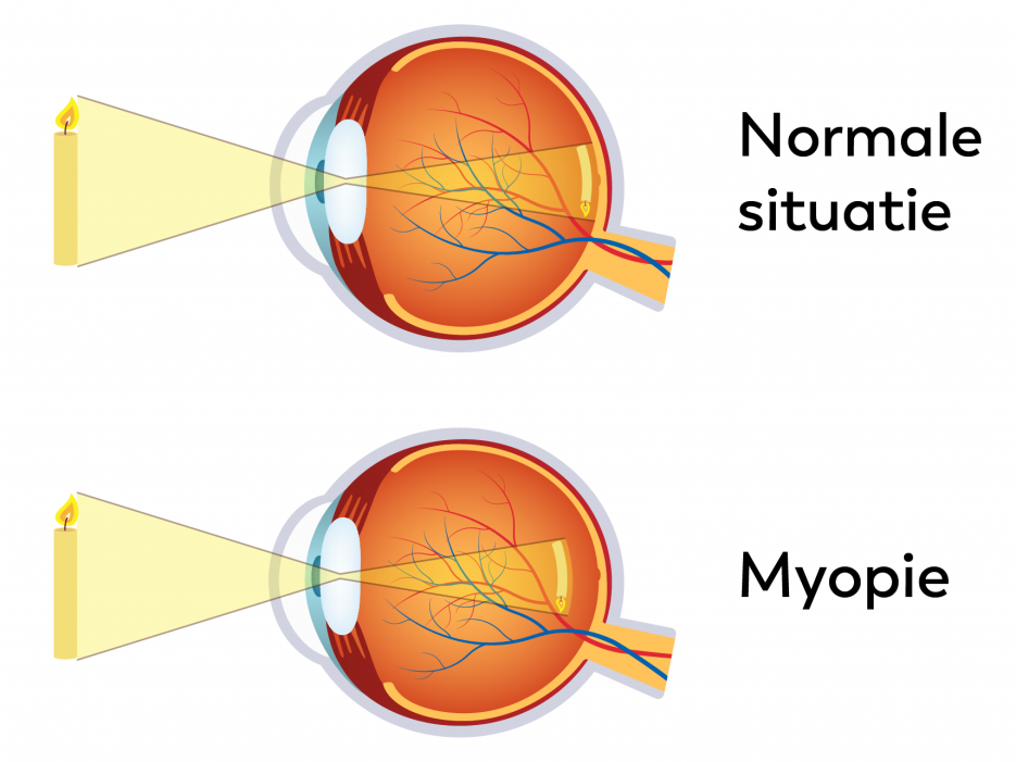 Normale situatie en situatie bij Myopie aandoening aan het oog