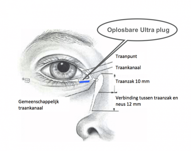 oplossing tranende ogen oplosbare ultra plug