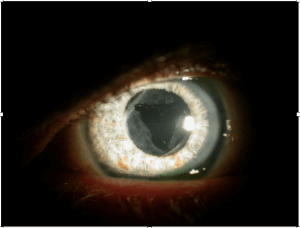 Rechter oog met een kunstlensje achter de pupilopening
