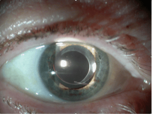 Rechter oog had nastaar, is behandeld met YAG-Laser