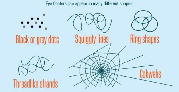 verschillende eye floaters