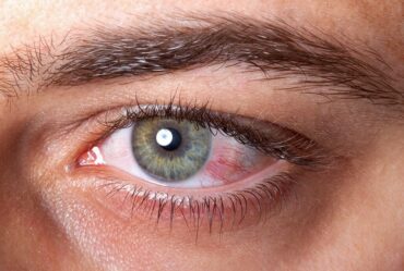 close up of irritated red blood eye