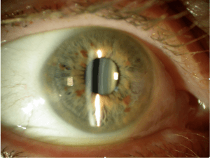 Hoe ziet beginnend cataract eruit?